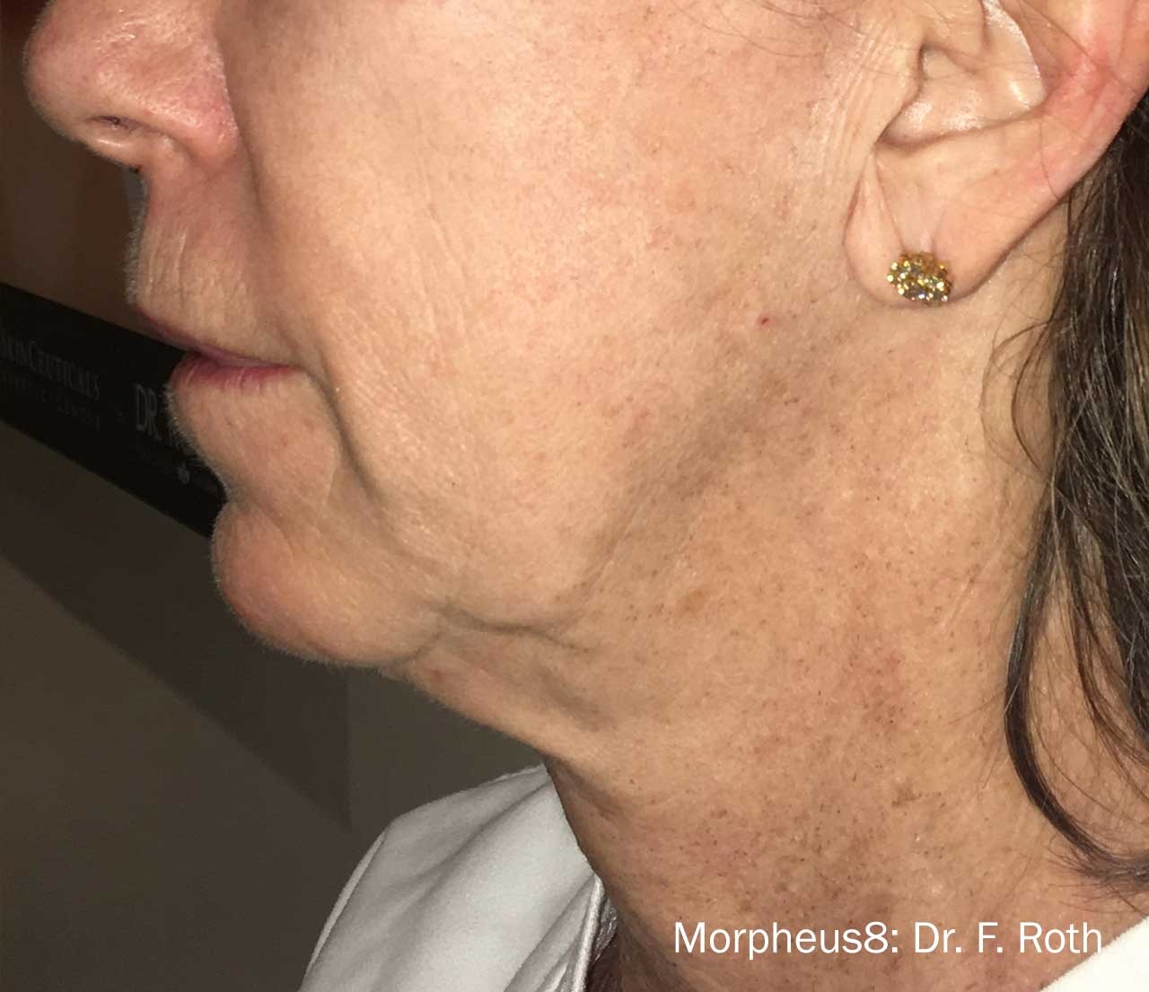 Face & neck after Morpheus8 treatment