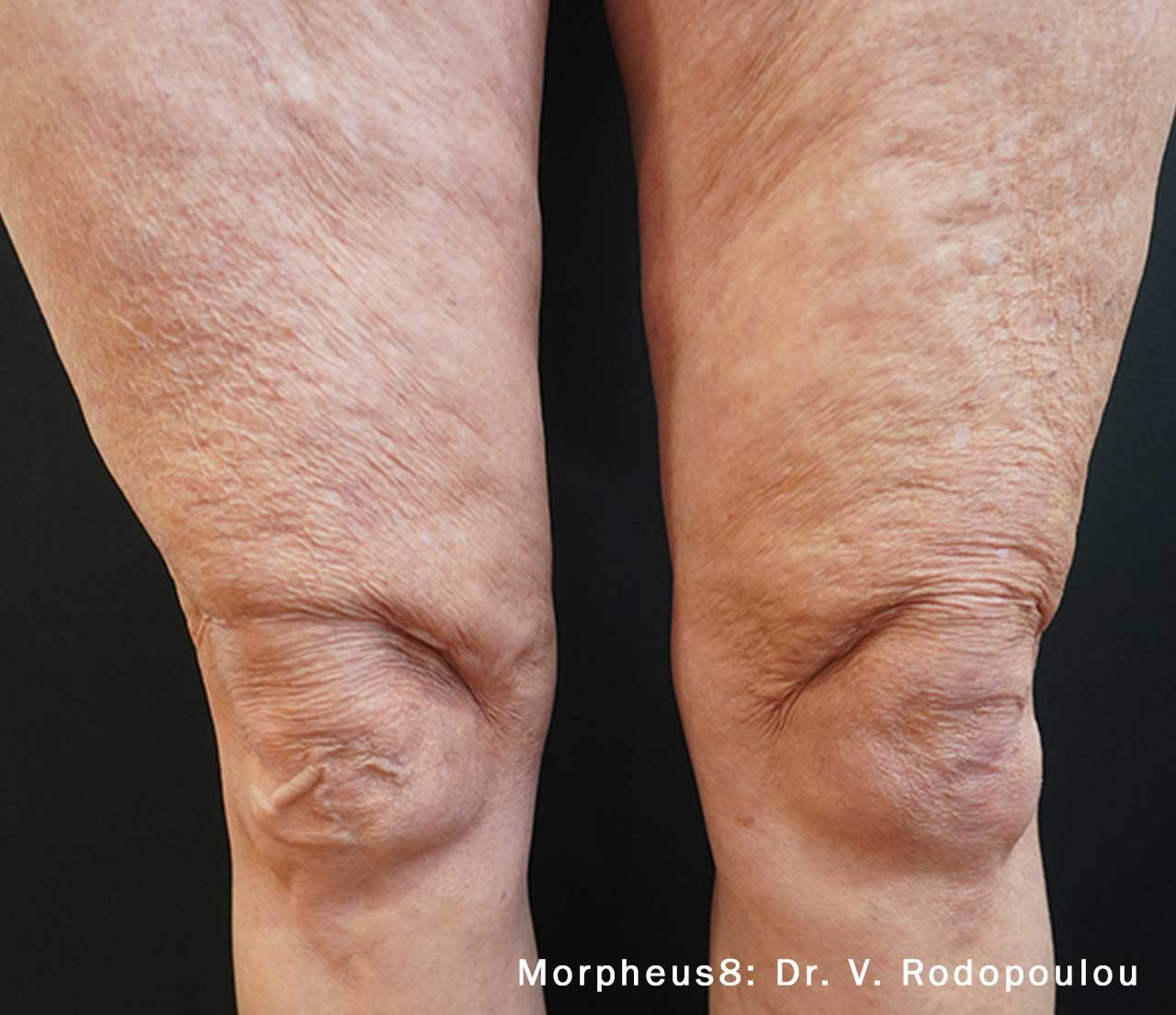 Thighs after Morpheus8 treatment